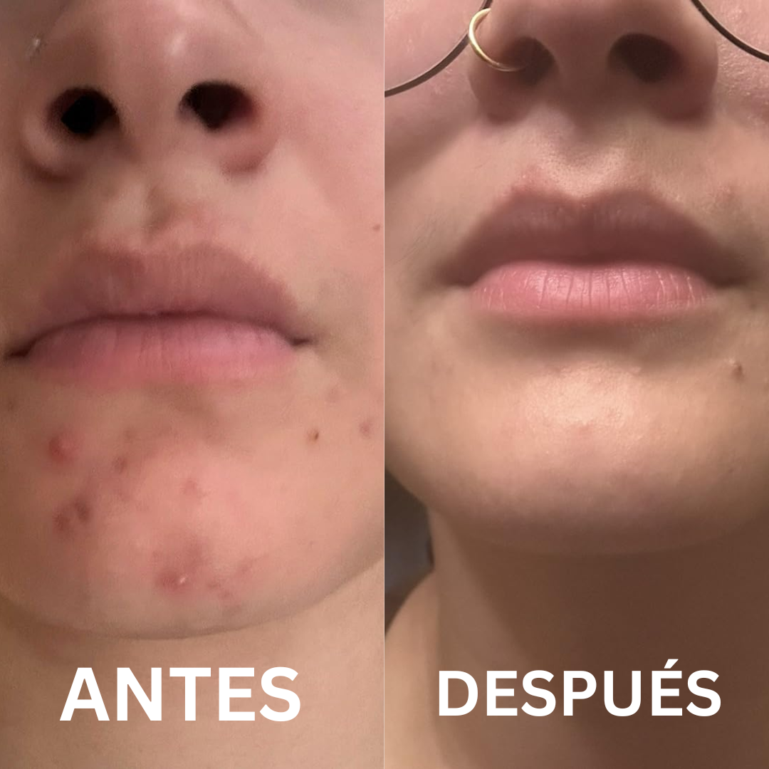 DermaPulse Pro + SERUM VITAMINA C - Elimina el acne en semanas