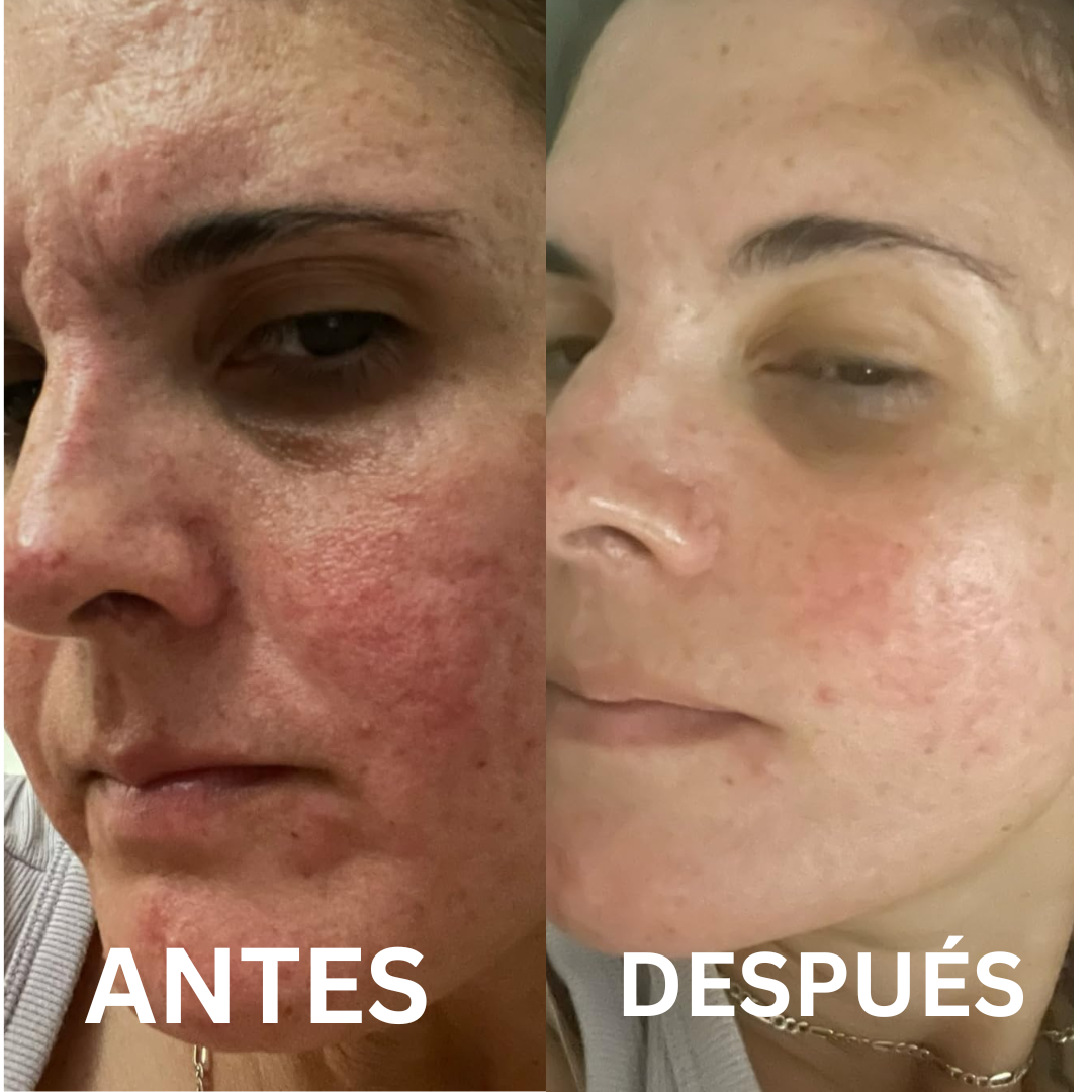 DermaPulse Pro + SERUM VITAMINA C - Elimina el acne en semanas