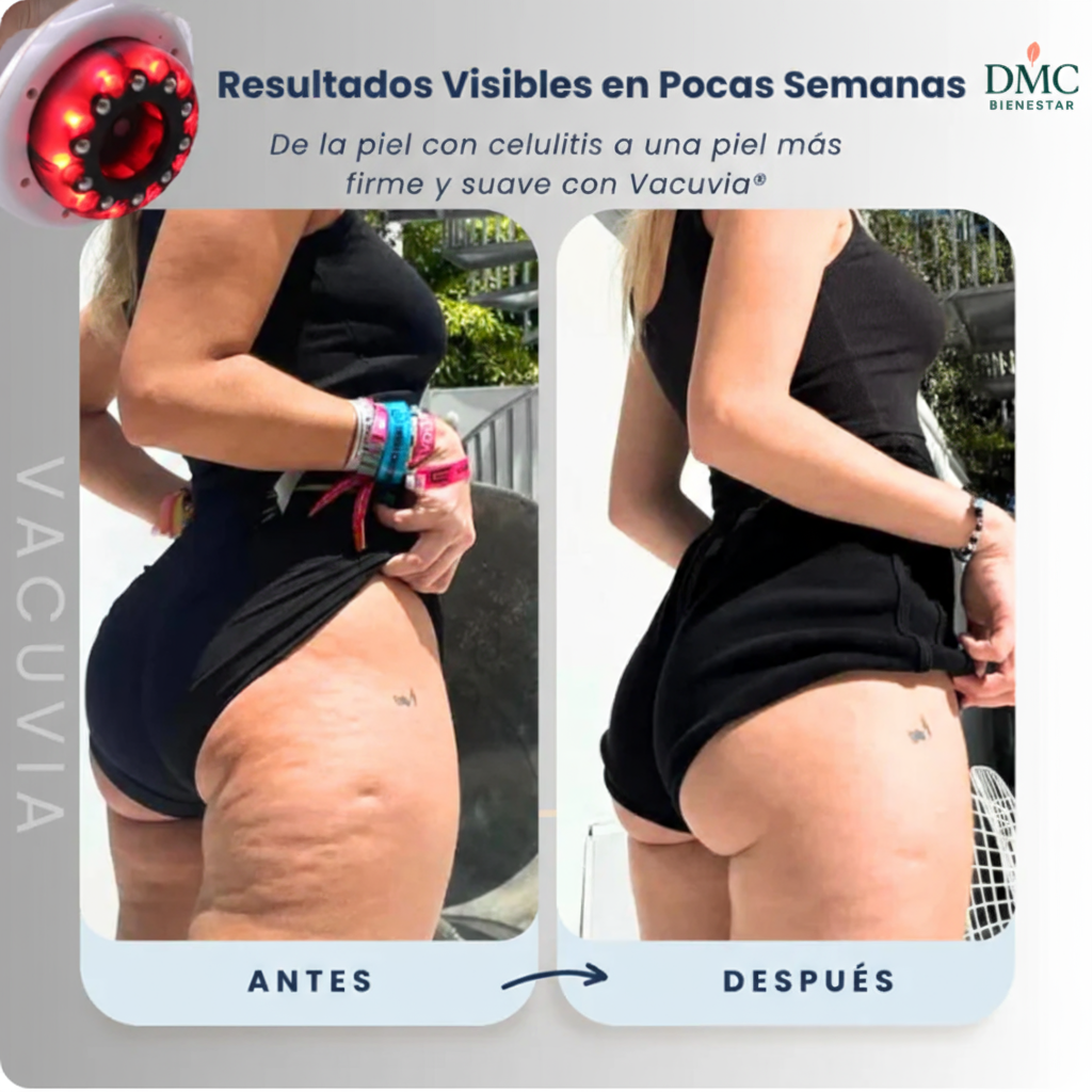 DMC®﻿ GlowCup™ - ELIMINA LA CELULITIS EN 4 SEMANAS