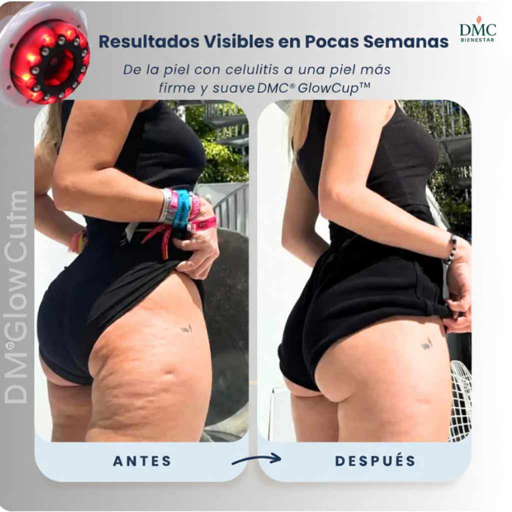 DMC®﻿ GlowCup™ - ELIMINA LA CELULITIS EN 4 SEMANAS